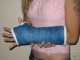 Selling an arm cast on ebay